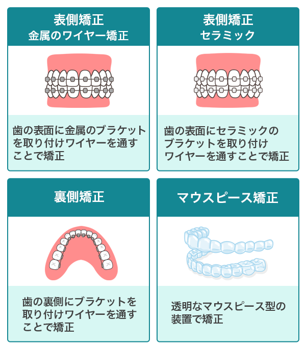 歯科矯正の種類とそれぞれの費用相場